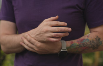 man with burn on his hand